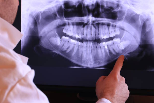 Best Emergency Wisdom Teeth Removal in Kingsport, TN