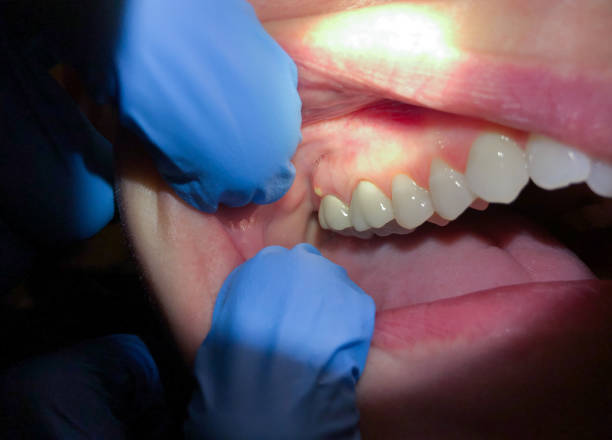Best Emergency Treatment for Dental Infections or Abscesses in Kingsport, TN