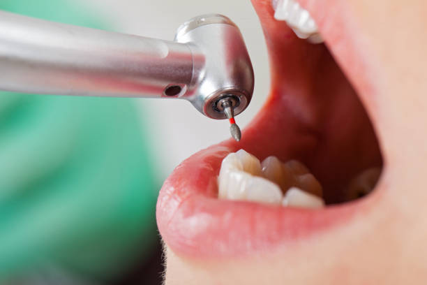 Best Emergency Root Canal Treatment in Kingsport, TN